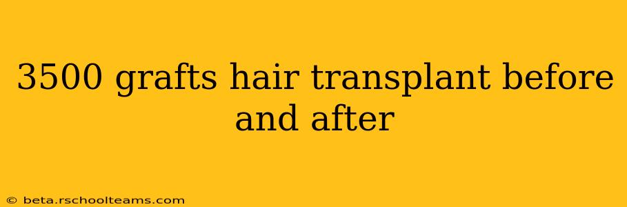 3500 grafts hair transplant before and after