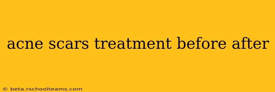 acne scars treatment before after