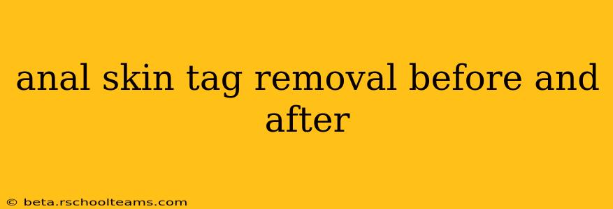 anal skin tag removal before and after