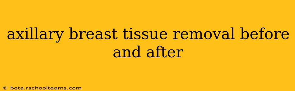 axillary breast tissue removal before and after