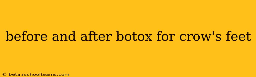 before and after botox for crow's feet