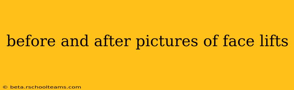 before and after pictures of face lifts