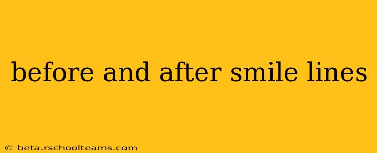 before and after smile lines