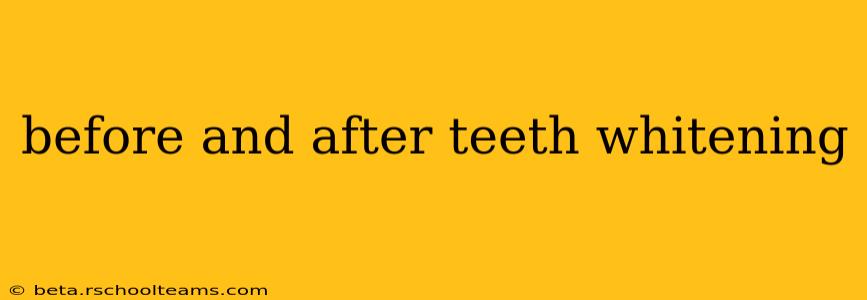 before and after teeth whitening