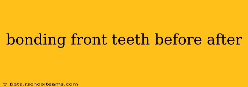 bonding front teeth before after