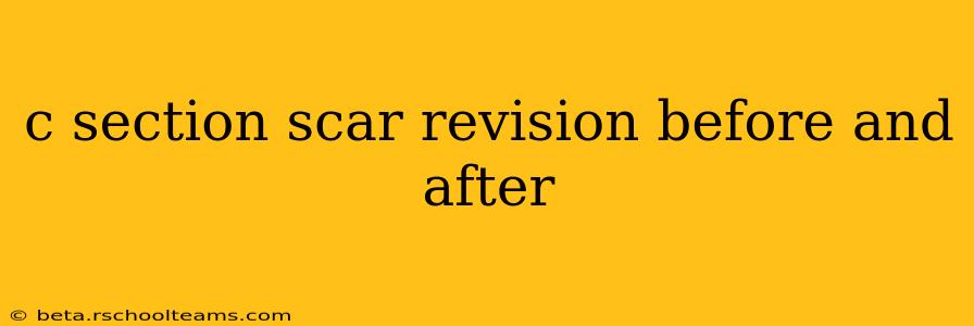 c section scar revision before and after