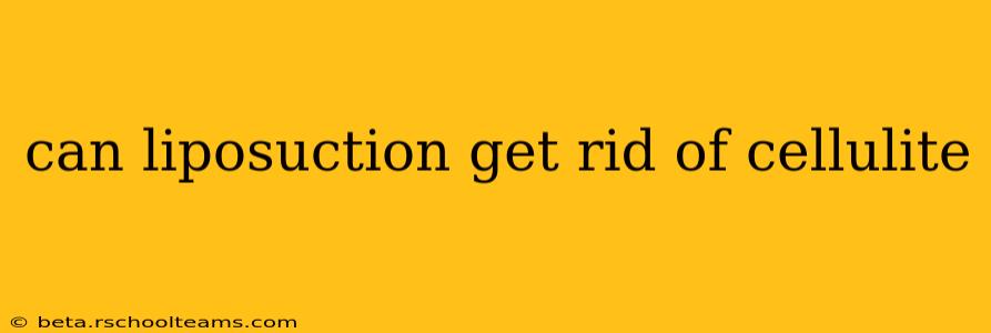 can liposuction get rid of cellulite