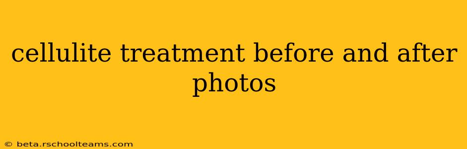 cellulite treatment before and after photos