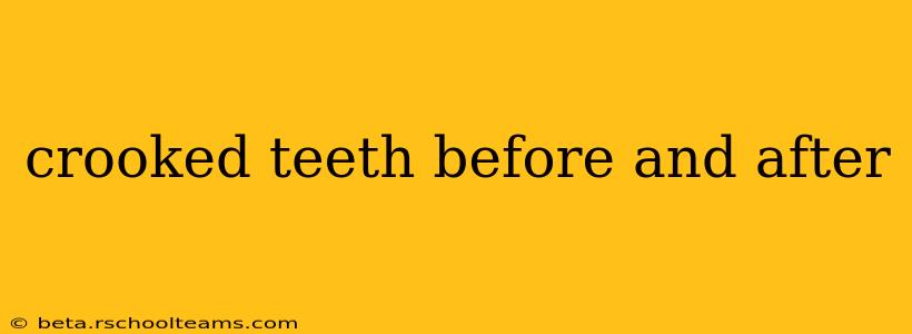 crooked teeth before and after