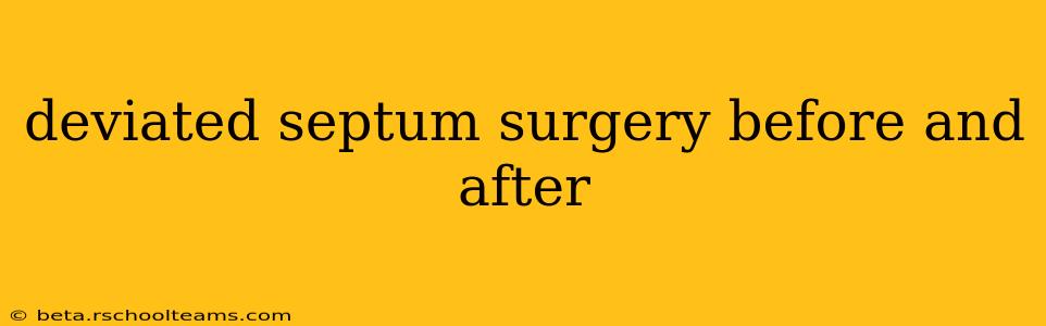 deviated septum surgery before and after