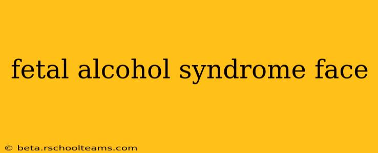 fetal alcohol syndrome face