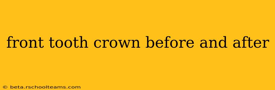 front tooth crown before and after