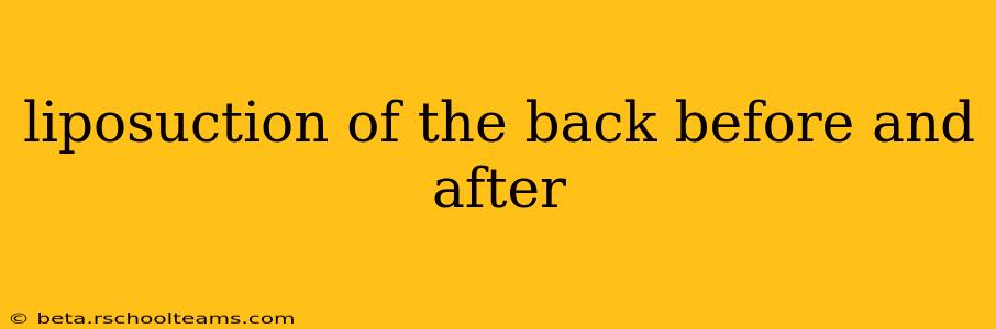 liposuction of the back before and after