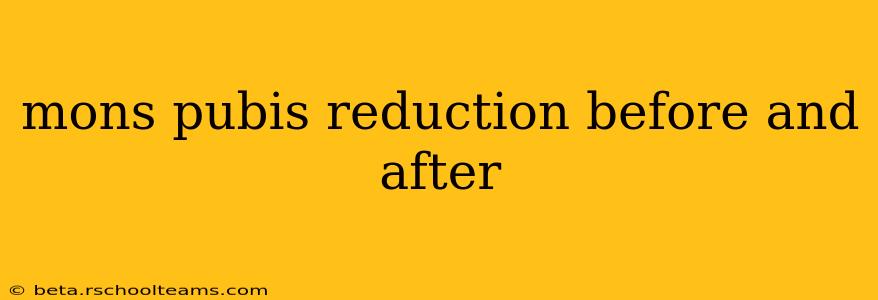 mons pubis reduction before and after