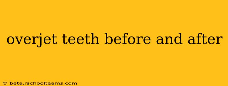overjet teeth before and after