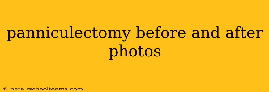 panniculectomy before and after photos