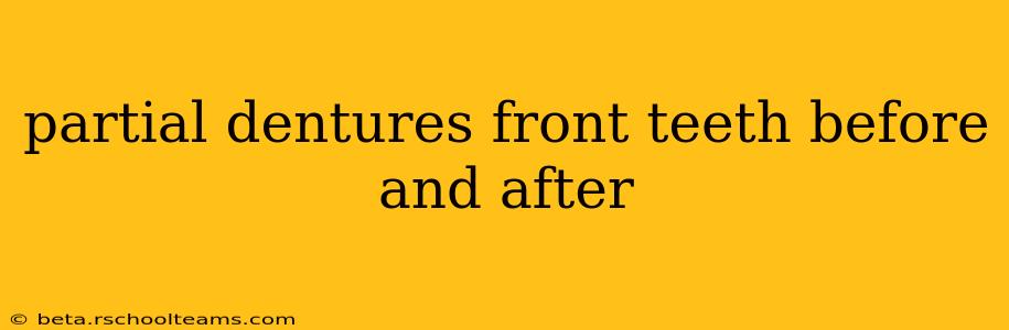 partial dentures front teeth before and after