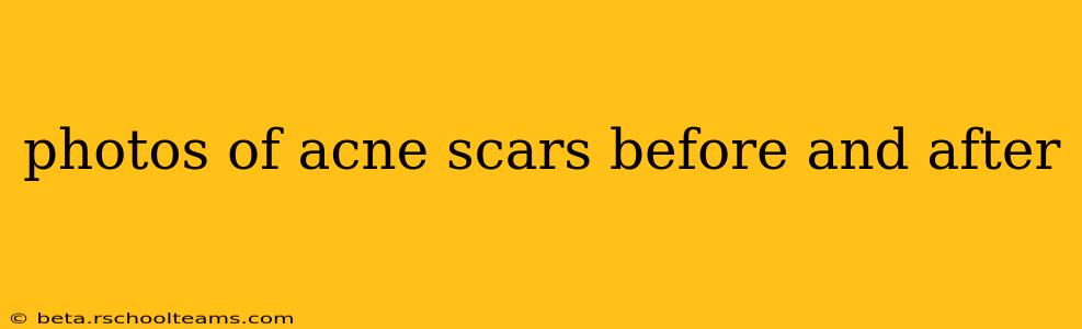 photos of acne scars before and after