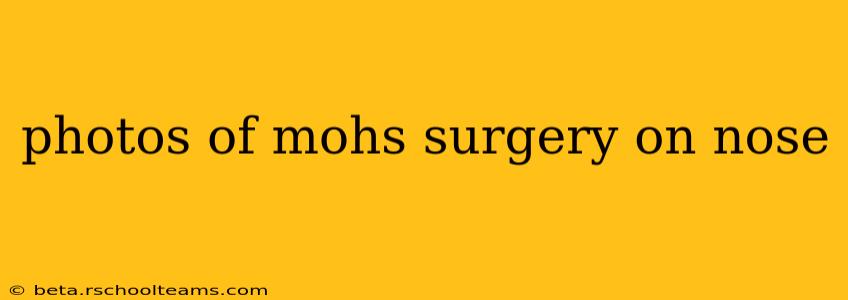 photos of mohs surgery on nose