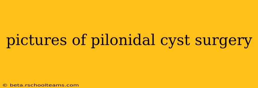 pictures of pilonidal cyst surgery