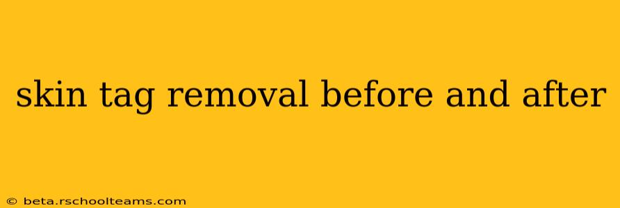 skin tag removal before and after