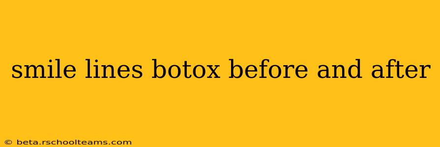 smile lines botox before and after