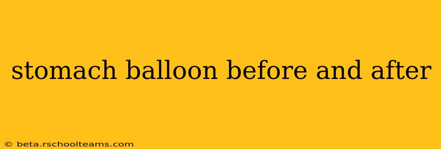 stomach balloon before and after
