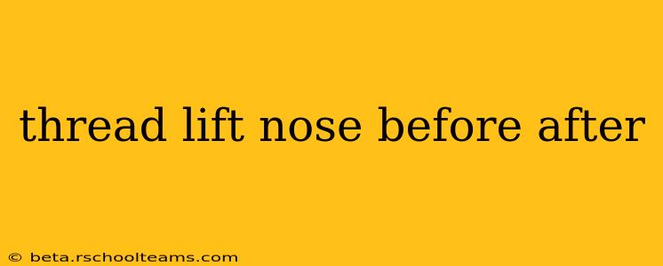 thread lift nose before after