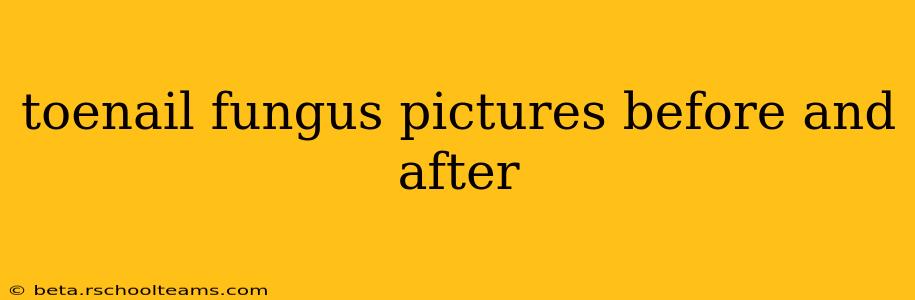 toenail fungus pictures before and after