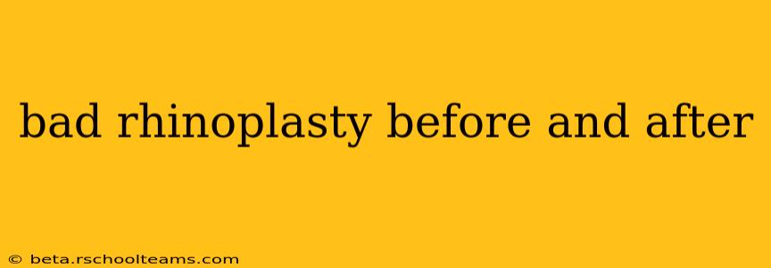 bad rhinoplasty before and after