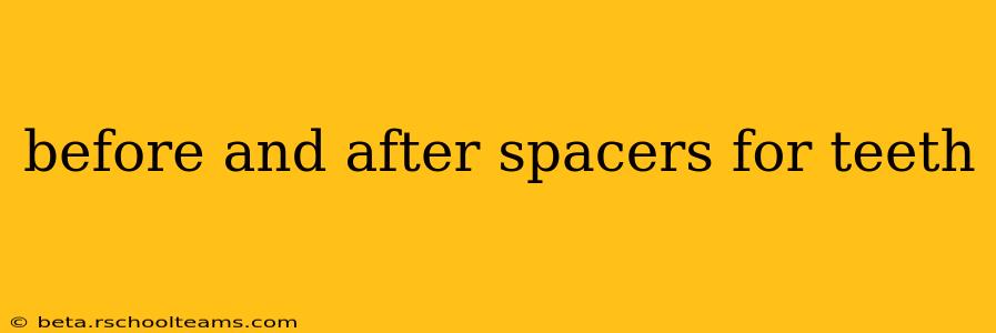 before and after spacers for teeth