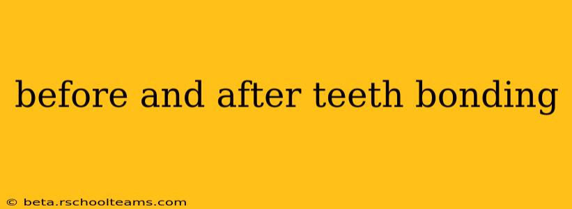 before and after teeth bonding