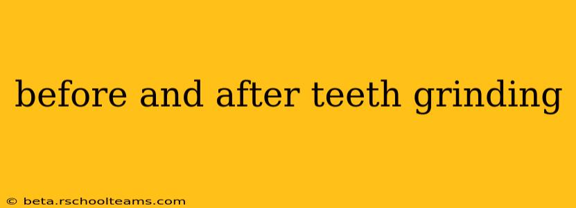 before and after teeth grinding