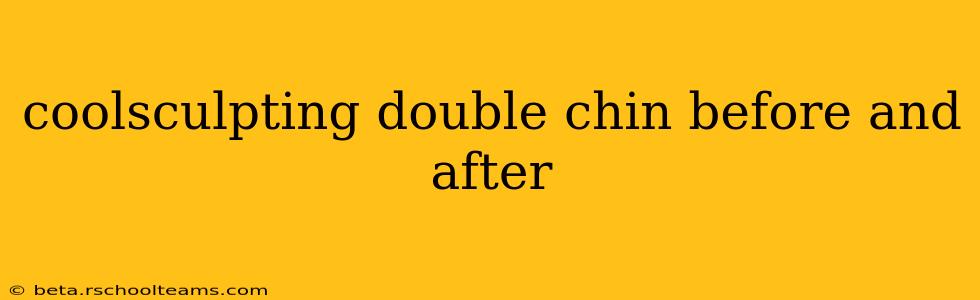coolsculpting double chin before and after