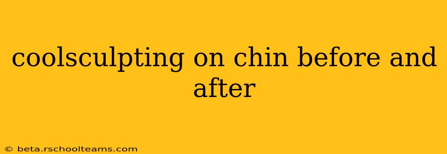 coolsculpting on chin before and after