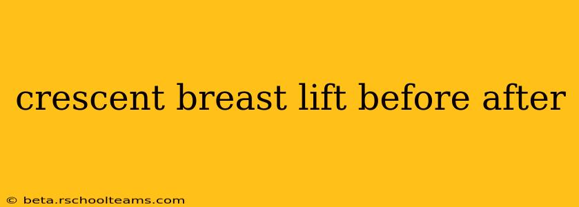crescent breast lift before after