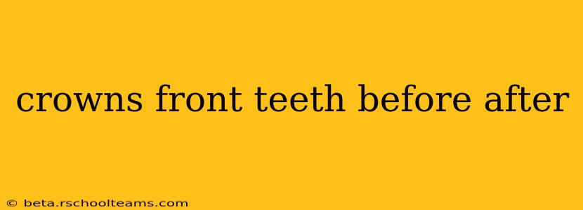 crowns front teeth before after
