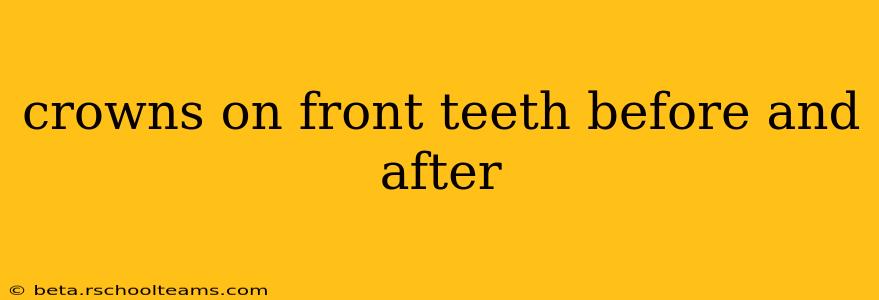 crowns on front teeth before and after