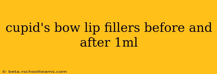 cupid's bow lip fillers before and after 1ml