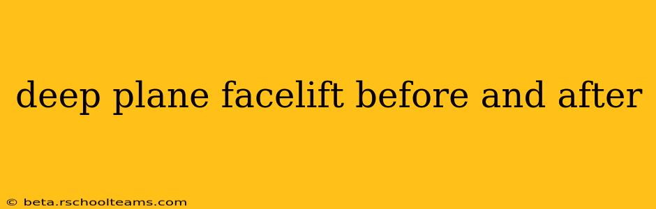 deep plane facelift before and after