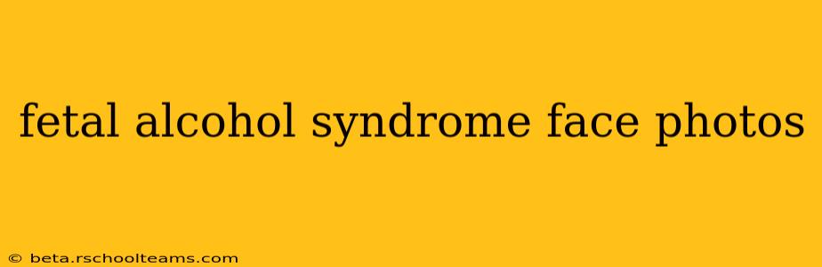 fetal alcohol syndrome face photos