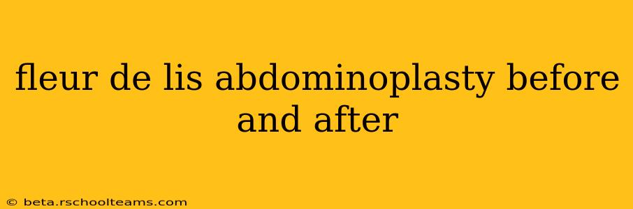 fleur de lis abdominoplasty before and after