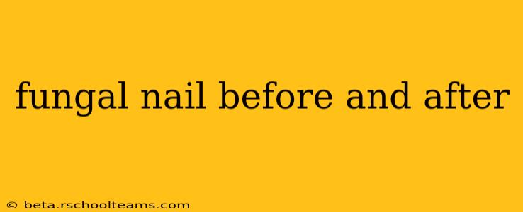 fungal nail before and after