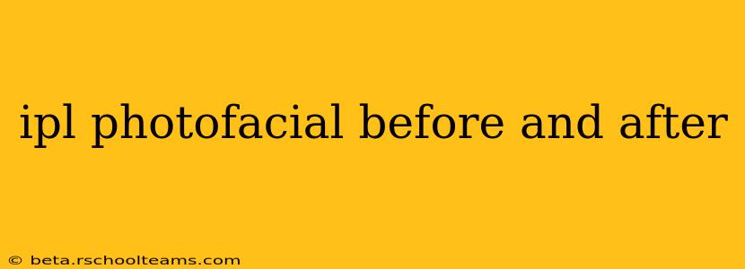 ipl photofacial before and after