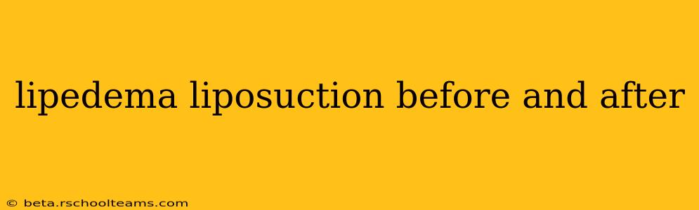 lipedema liposuction before and after