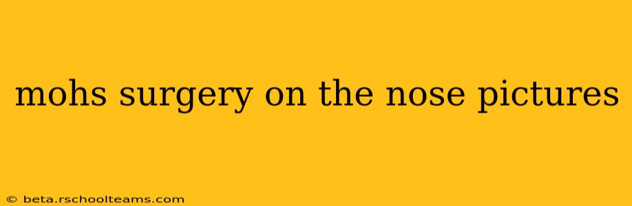 mohs surgery on the nose pictures