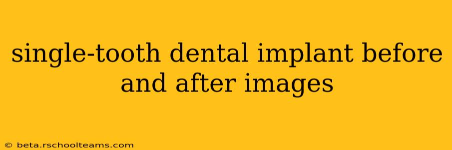single-tooth dental implant before and after images