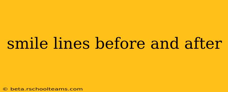 smile lines before and after