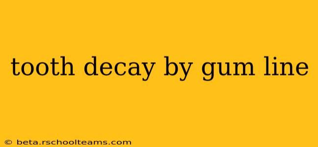 tooth decay by gum line