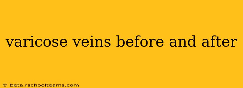 varicose veins before and after